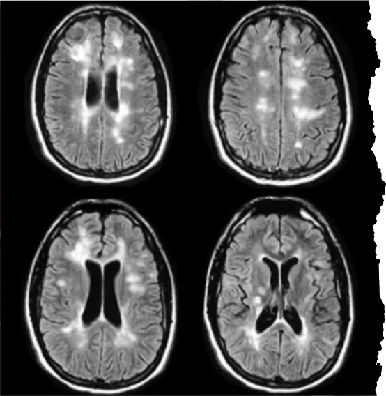 MS-brain-scan